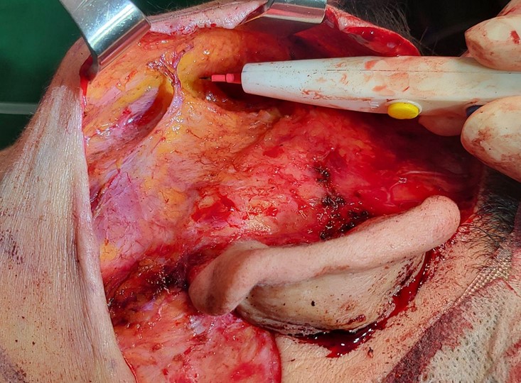 How effective is the incision method compared to the non-incision method for cheek hollow correction? image 10