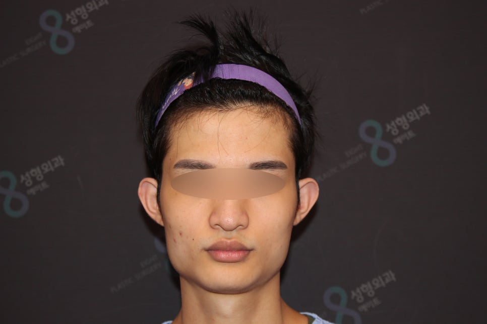 Male Facial Contouring (Square Jaw Surgery, Cheekbone Surgery, Chin Surgery) - Explained by a Specialist image 1