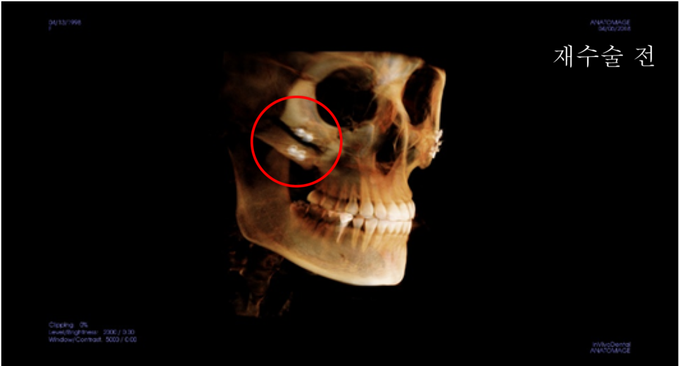 A Complete Summary of 6 Complications After Cheekbone Surgery: Sinusitis, Recurrence, Hollow Cheeks, and Sagging Cheeks image 4
