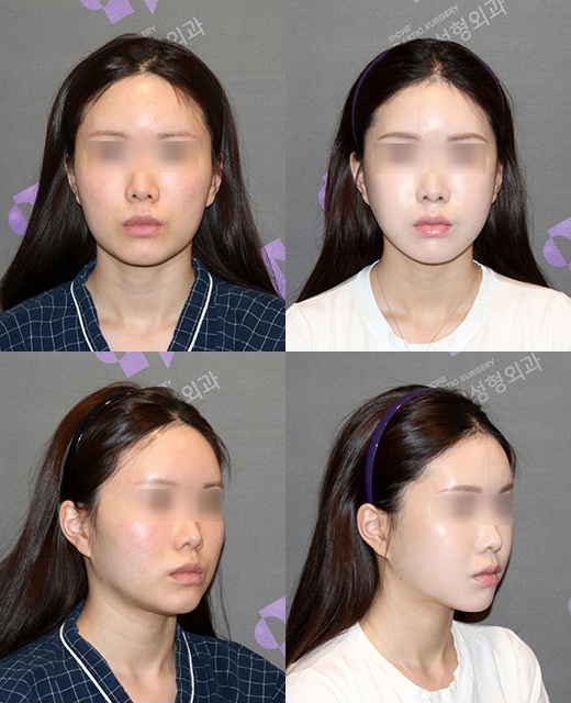 광대축소술, 내 광대뼈는 얼마나 줄어들 수 있나요? 관련 이미지 7
