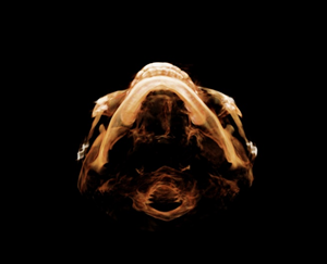 After Facial Contouring Surgery: Asymmetry, When Can Revision Surgery Be Performed? image 8