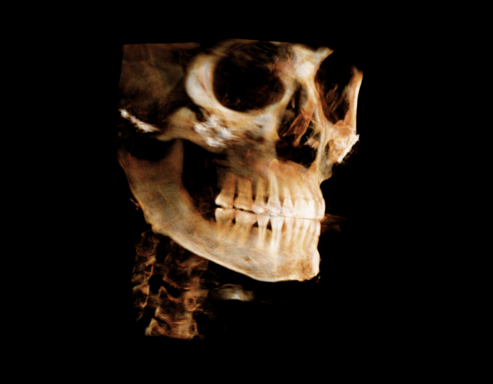 After Facial Contouring Surgery: Asymmetry, When Can Revision Surgery Be Performed? image 3