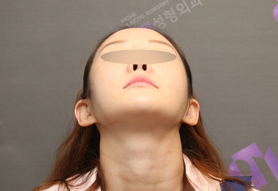 옆광대수술후기, 사례와 함께 알아보기 - 전문의가 직접알려드립니다. 관련 이미지 7