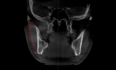About Masseter Reduction Surgery for Improving the Frontal Effect of the Lower Face image 4