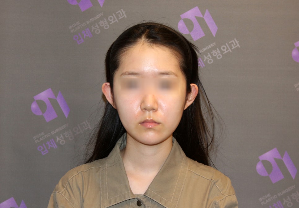 사각턱수술, 피질절골과 외측피질쉐이빙의 차이 관련 이미지 11