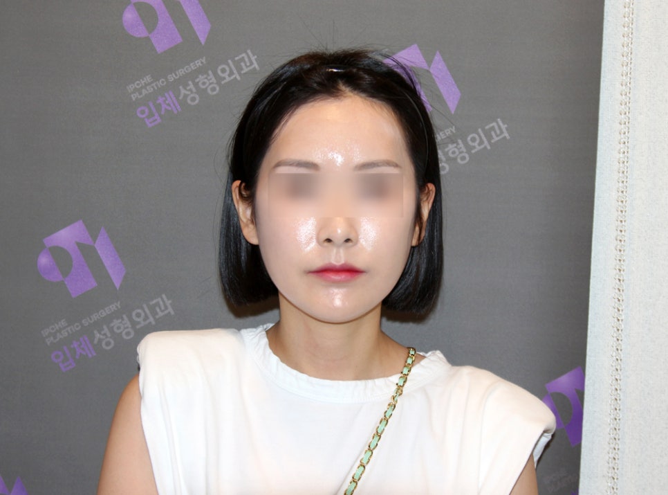 사각턱교정 부작용 개턱 예방에 수술디자인의 중요성 관련 이미지 3