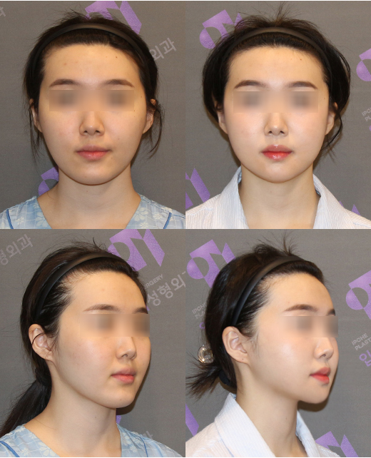 안면윤곽수술 몇 살부터 가능한가요? - 성형외과 전문의가 알려드립니다. 관련 이미지 3