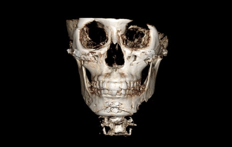 Are There People Who Can’t Have Cortical Ostectomy Surgery for a Frontal Square Jaw Effect? image 7