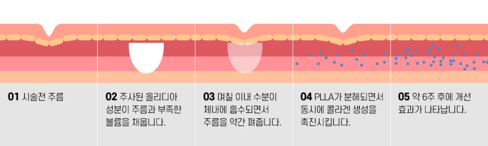 Collagen Injection That Does It All, from Skin Boosters to Volume Fillers: Olidia image 2