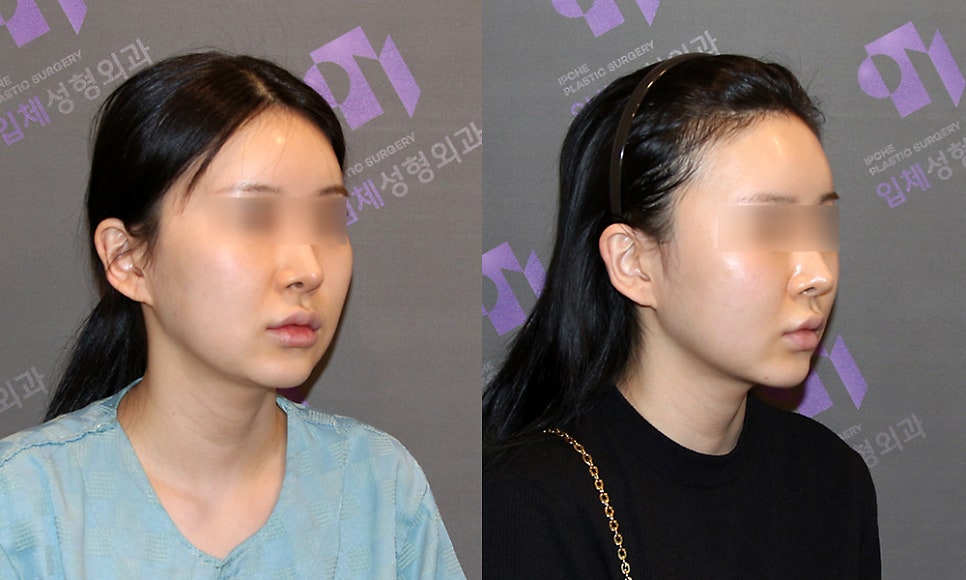 얼굴뼈 광대뼈 축소, 쉐이빙할 수 있는 부위와 효과는 어느정도 될까요? 관련 이미지 10