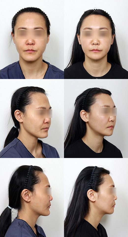 턱끝수술 종류 총정리, 전진술부터 뼈이식까지 관련 이미지 9