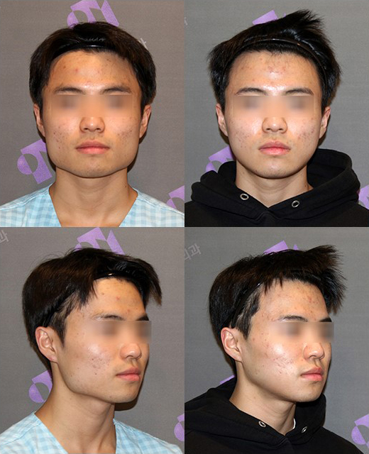 남자사각턱수술이 여자와 다른 이유는? 관련 이미지 6