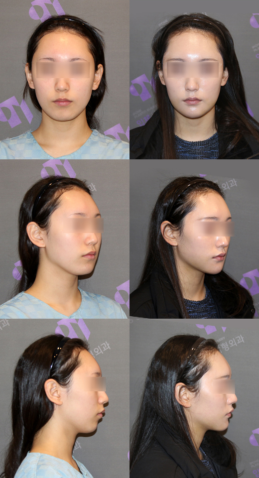 Chin Implants and Chin Advancement Surgery: Real Surgical Cases and What to Know image 5