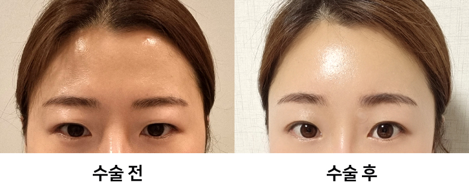 Endoscopic Forehead Lift Swelling and Recovery Time: Looking at It with Before-and-After Photos image 10