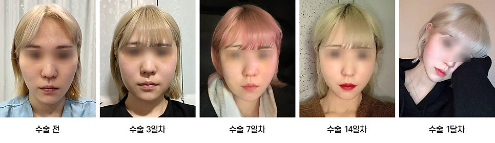 안면윤곽 수술 후 붓기, 일상생활은 언제부터 가능한가요? 케이스별로 알아보기 관련 이미지 2