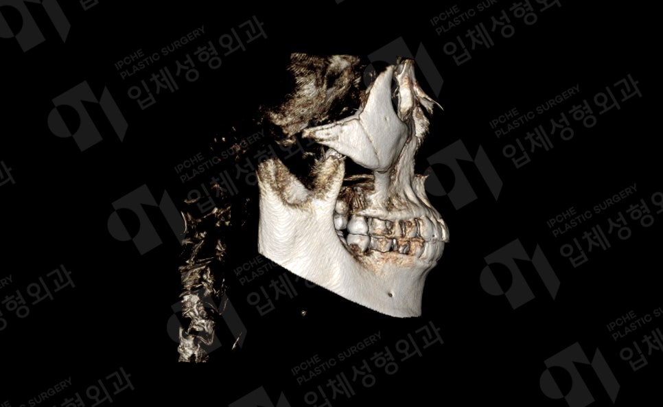 Why Consultation and Design Are Important Before Facial Contouring Surgery—Don’t Be Careless!! image 4