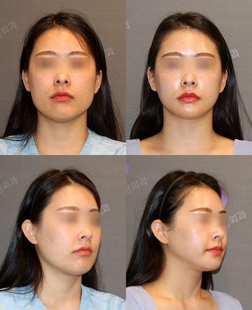 이런 분들은 윤곽수술 대신 다른 수술을 먼저 생각해보세요! 관련 이미지 6