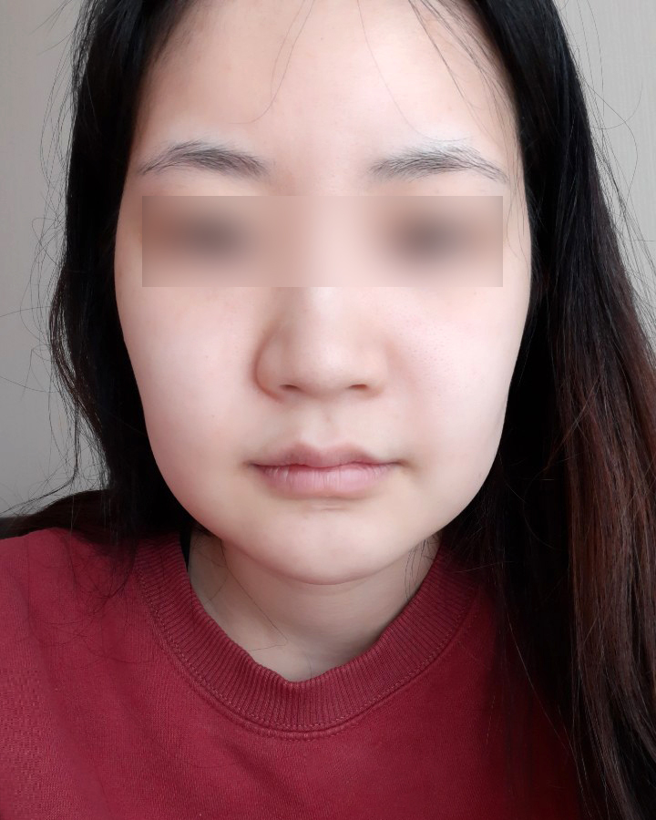 땅콩형 얼굴은 어떻게 개선할 수 있을까요? 관련 이미지 1