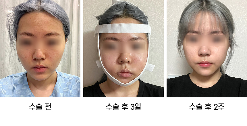 Do Not Confuse Facial Contouring Sagging with Swelling! image 5