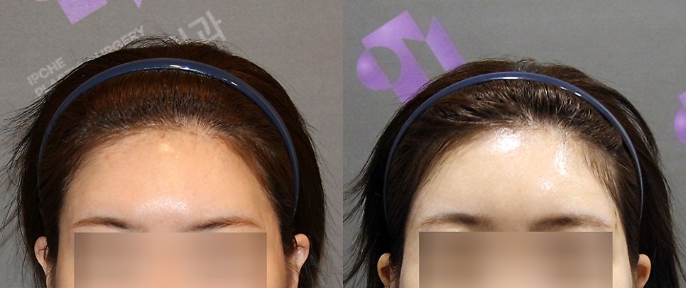 Forehead Fat Grafting Side Effects: Is There a Way to Remove Excess Fat? image 11