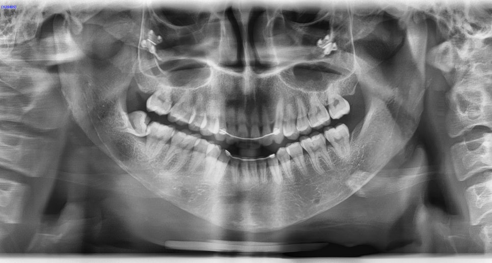 Long Chin, Long Face Contouring - Cases That Do Not Require Double Jaw Surgery image 6