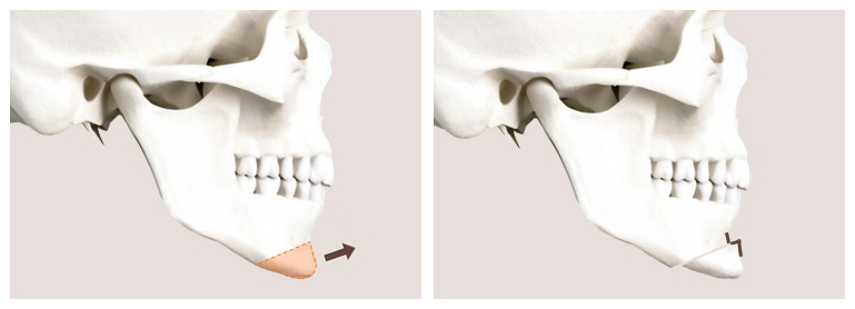 Can Chin Advancement Surgery Adjust Chin Length? image 2