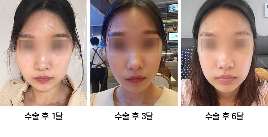 Do Not Confuse Facial Contouring Sagging with Swelling! image 2