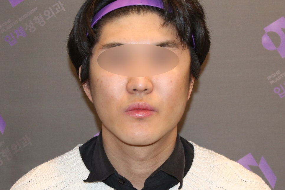 Male Cheekbone Reduction Surgery: Looking at Real Cases of Facial Contouring Surgery image 4