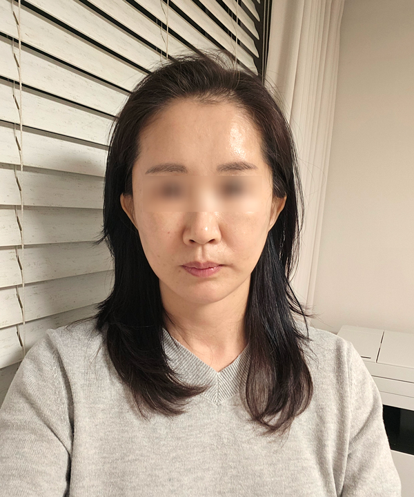 Facelift Recovery Period: When Will My Face Look Natural Again? image 6