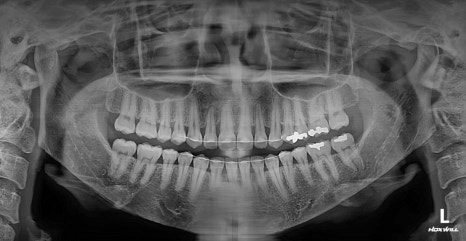 Long Midface and Lower Face Long-Face, Long-Chin Surgery - Cases That Do Not Require Double-Jaw Surgery image 17