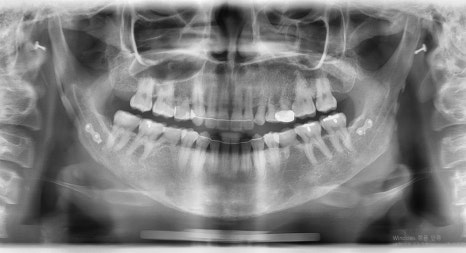 Is Pin Removal Surgery Necessary After Facial Contouring? What About Swelling and Recovery Time? image 4
