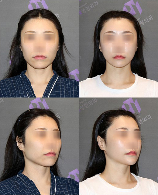 [Chin Surgery] Learning About Contouring Shaving and T-Osteotomy with Real Patient Cases (3) image 8