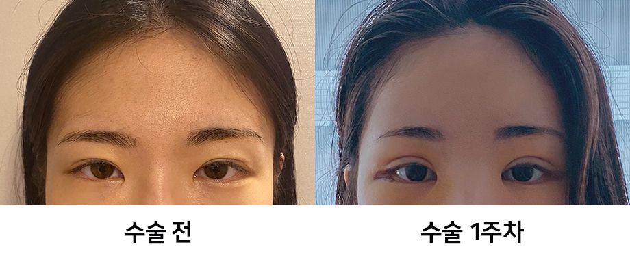 Endoscopic Forehead Lift Swelling and Recovery Time: Looking at It with Before-and-After Photos image 6