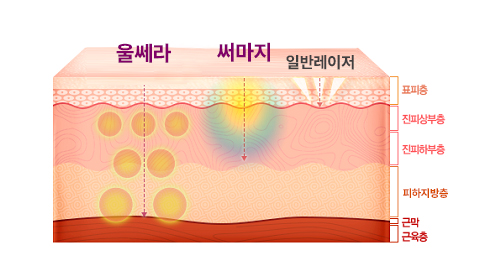 윤곽수술 후 핀이 남아있는데 울쎄라나 써마지 해도 괜찮을까요? 관련 이미지 2