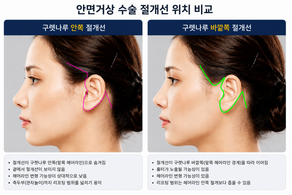40대 안면거상 vs 60대 안면거상 관련 이미지 2