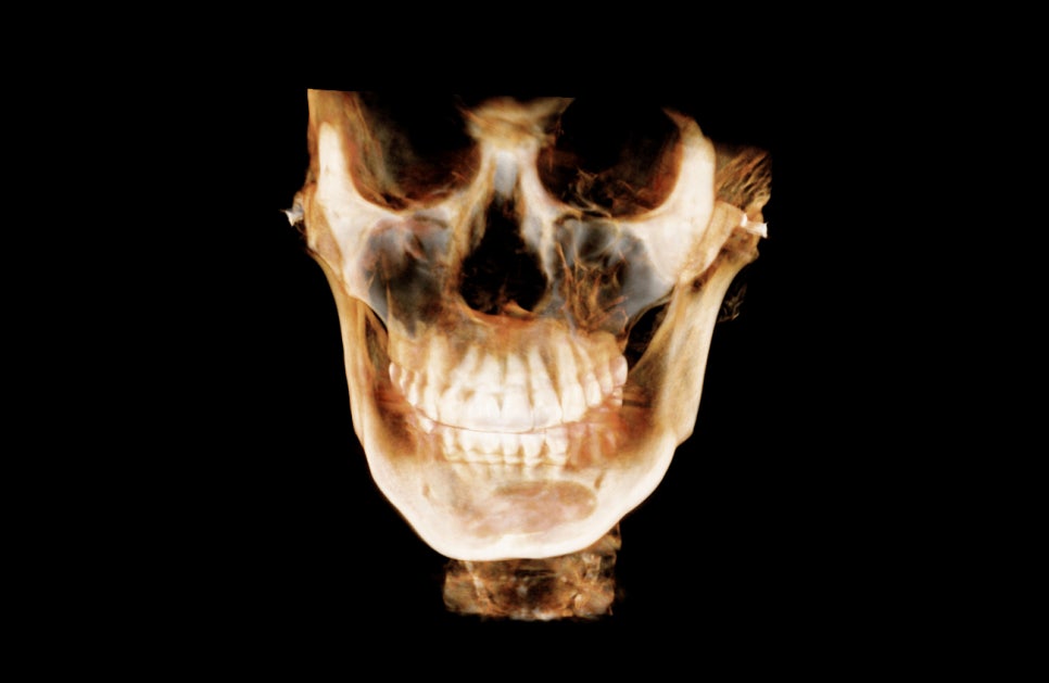 Does chin filler or an implant cause bone erosion? image 3