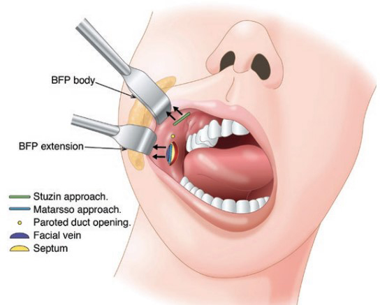 The Importance of Buccal Fat Removal in Facelift Surgery image 3
