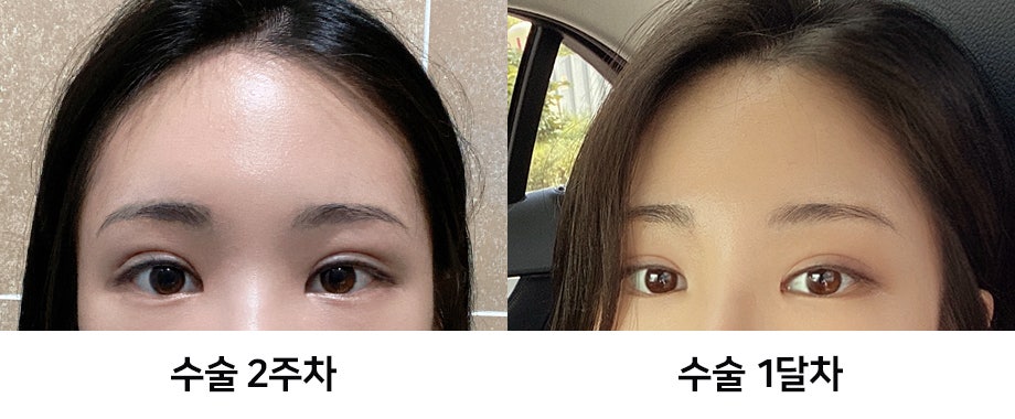Endoscopic Forehead Lift Swelling and Recovery Time: Looking at It with Before-and-After Photos image 7
