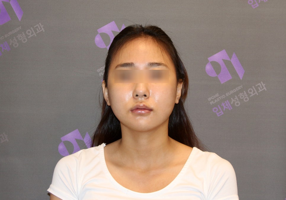 안면윤곽수술 후 붓기, 일차별(1일~30일차)사진과 함께 회복기간 알아보기 관련 이미지 3