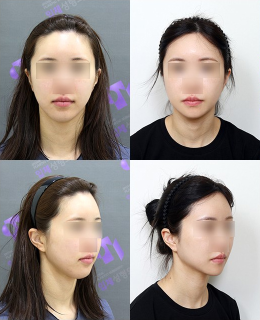 광대축소술 후 긴얼굴이 더 길어 보일까요? 관련 이미지 2