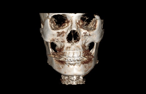 Are There People Who Can’t Have Cortical Ostectomy Surgery for a Frontal Square Jaw Effect? image 13