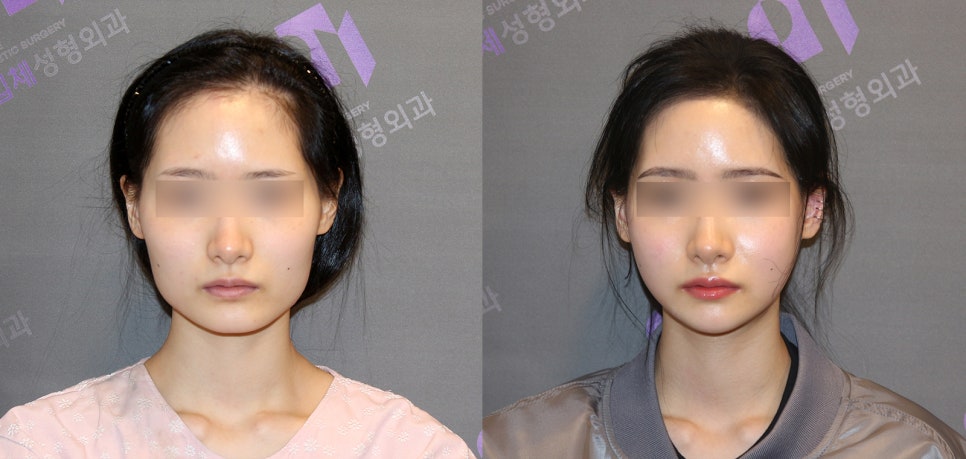 Side Effects of V-Line Square Jaw Surgery, Common Traits of People Who Experience Failed Results image 6