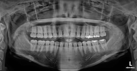 Long Midface and Lower Face Long-Face, Long-Chin Surgery - Cases That Do Not Require Double-Jaw Surgery image 16