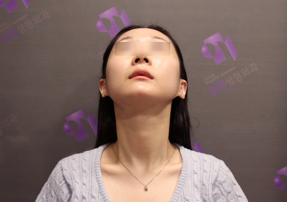 안면윤곽 볼처짐 원인은 무엇인가요? (솔직한 생각) 관련 이미지 5