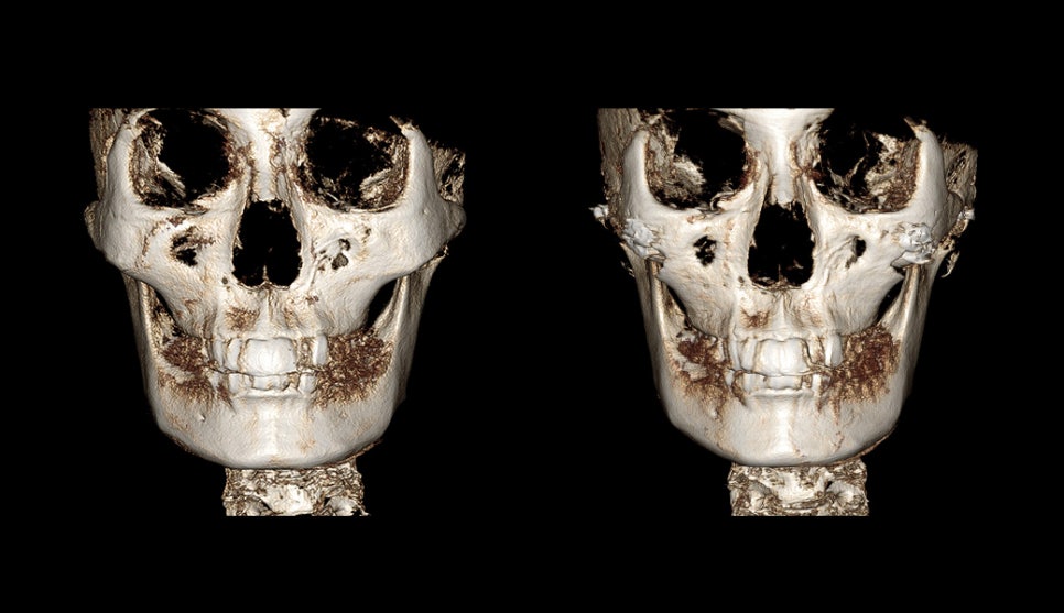 Consultation and Design Before Facial Contouring Surgery image 2