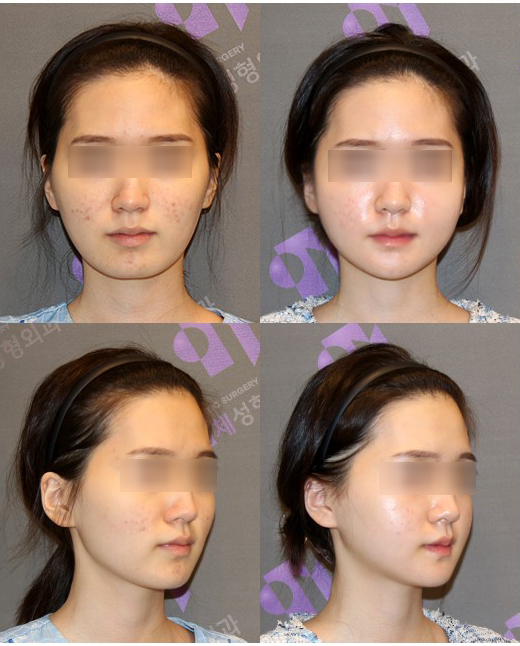 안면윤곽수술 후 피주머니 피통 꼭 착용해야 하나요? 관련 이미지 5