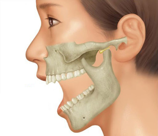Could Difficulty Opening the Mouth After Contouring Surgery Be a Side Effect? image 3
