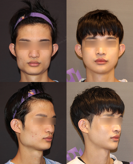 T절골 수술이라고 다 같은 수술이 아니예요! 관련 이미지 12
