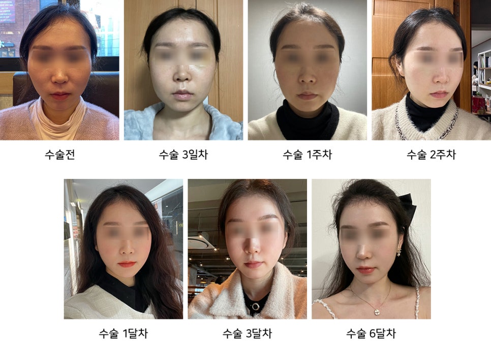 How to Reduce Swelling Quickly After Facial Contouring Surgery - Explained by a Plastic Surgeon image 3