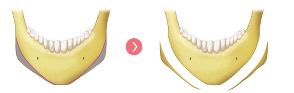 What Is Chin Surgery? image 6